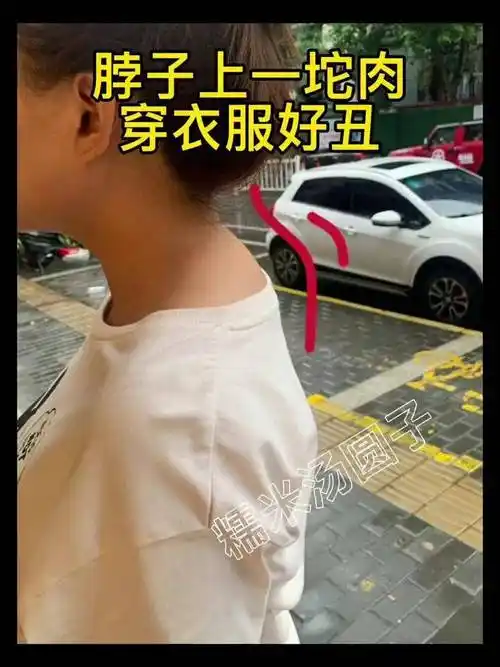 前倾太影响气质了吧,半个月月没见,闺蜜跟换了一个人似的颈椎 驼背