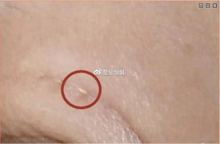 若发现线头冒出属于线头的排异反应