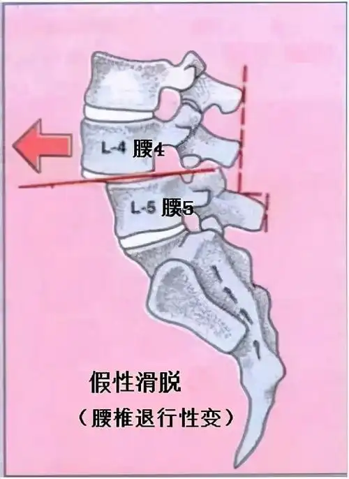 真性滑脱是由于腰椎的椎弓峡部先天发育异常或急性外伤,导致椎弓峡部