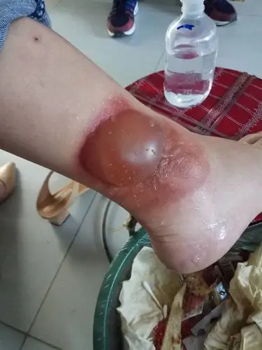 无痛治疗各种烧烫伤