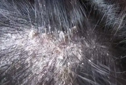 头部脂溢性皮炎应该久洗头日常脂溢性皮炎如何改善以及预防