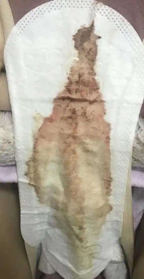 排卵期出血看起来很稀有图