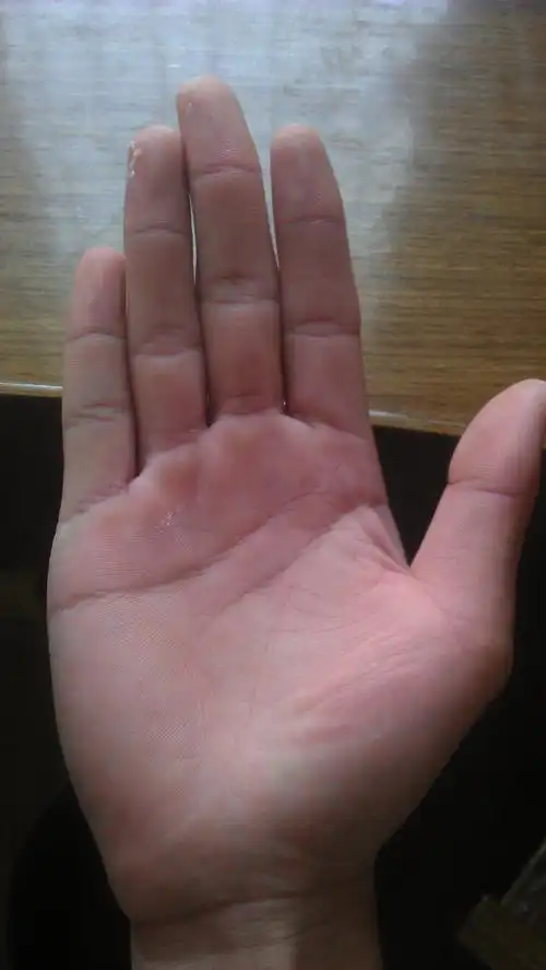 左手手心下今年突然长出颗痣