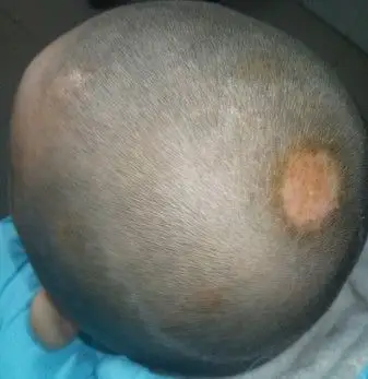 卫生引起来的,比如平时不喜欢洗头,从而导致头皮的发病率不断的增加