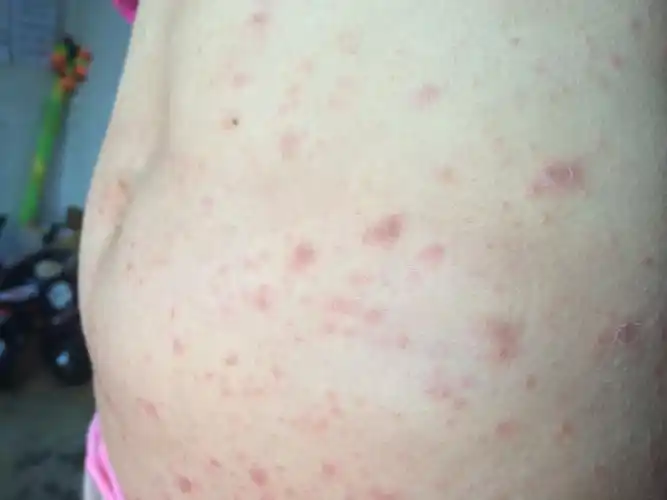 牛皮癣全身起了很多
