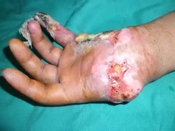 一只烂手的二期工程---一只手两个瓣