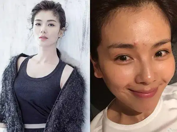 什么秦岚曾经同时长过一百多颗痘痘痘这个小妖精真是难治