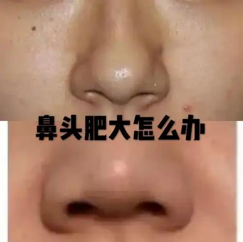 67鼻翼肥大鼻头圆钝怎么办