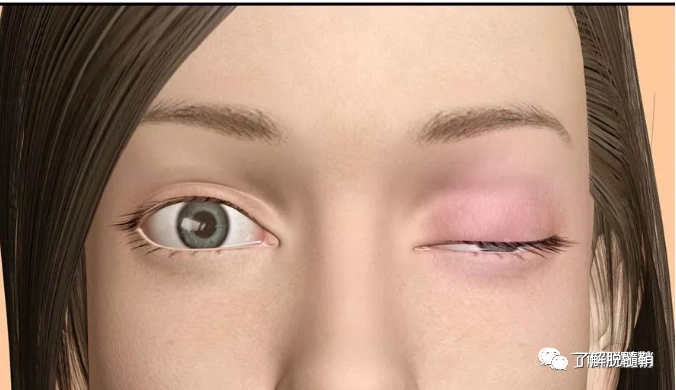 重症肌无力的高发人群有哪些