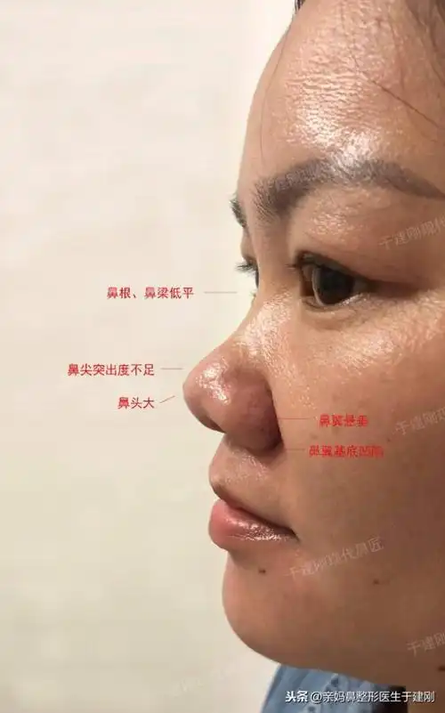 鼻头鼻翼整容鼻翼缩小术后秒变气质温柔辣妈