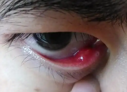 问:眼睑内长了个疮,点了左氧氟沙星,四五天过去了,现在上面起一个个的