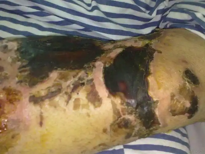 膝关节前侧皮肤坏死如何处理?