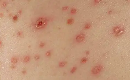 病毒性皮疹的预防感染