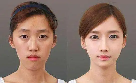 普通人整形vs明星整形整形对比图
