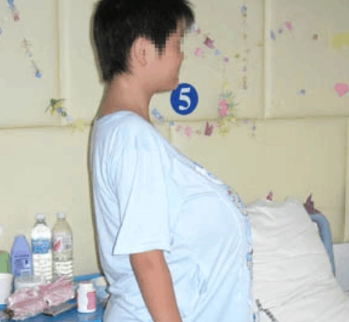 13岁女孩胸部大的异常受尽同学嘲笑手术过后让她重获新生