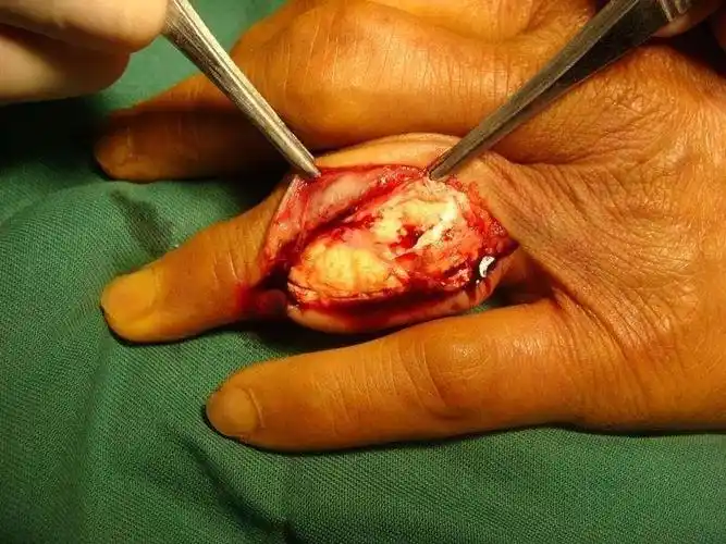 手指结晶,手术剔除!