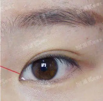 反人类下睑下至手术卧蚕丧失眼睑退缩睑外翻不舒服加老10岁