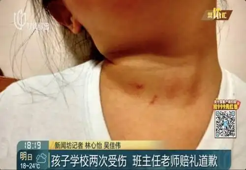 周浦某小学老师指甲抓伤一年级女生,是孩子太皮还是老师粗暴?