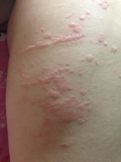 孩子后背突然起的疙瘩是什么_百度宝宝知道