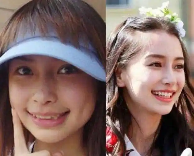 就是牙齿矫正了,牙齿矫正不但能让牙齿变整齐,还能改变一个人的脸型