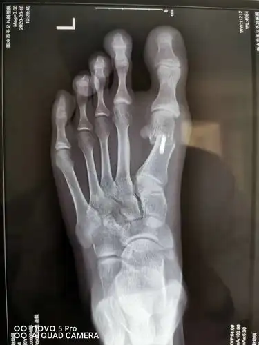 微创手术治疗拇外翻,医保报销,费用低,术后即可下地