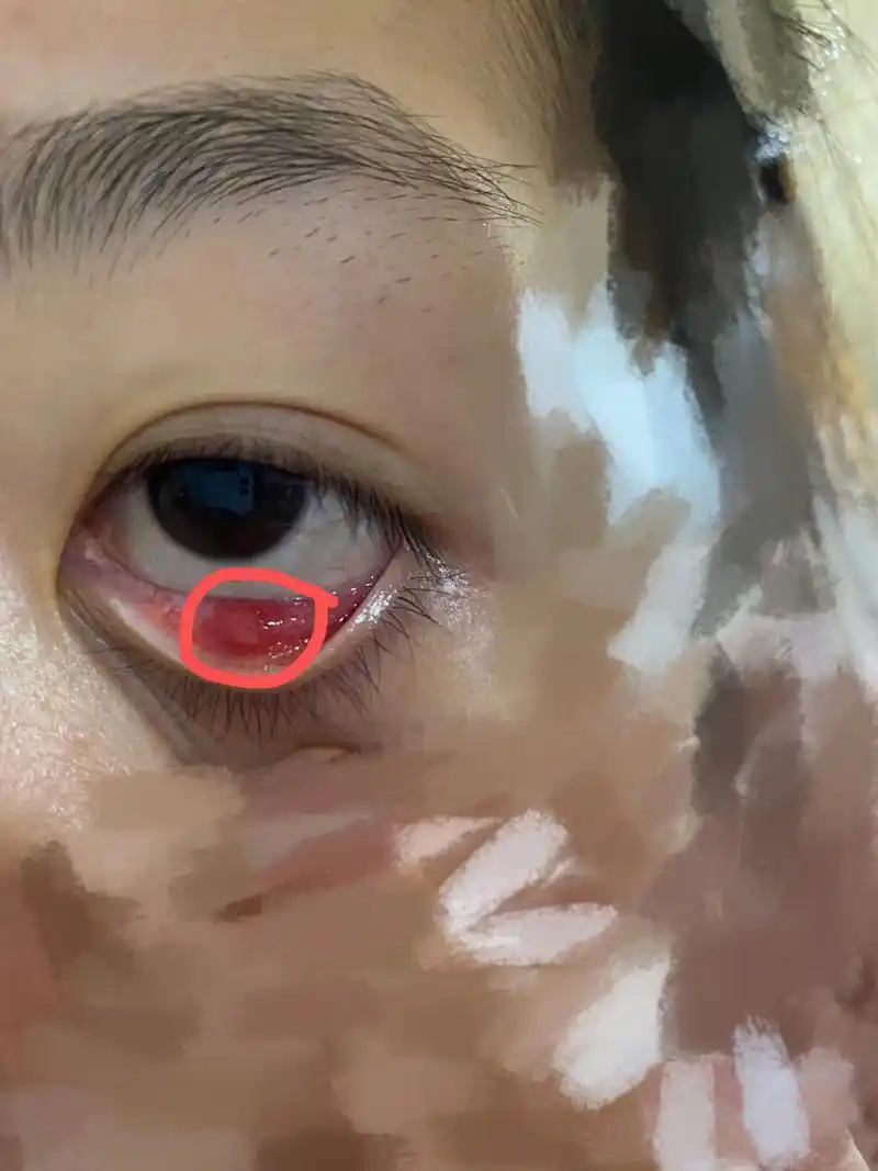 下眼皮子里面长了一颗黄色的水泡一样的东西 请问各