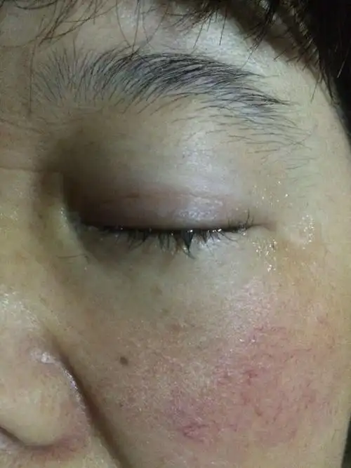 问:每天晚上睡觉后半夜眼睛浮肿,早上起床后眼角有白色胶质状,以前是