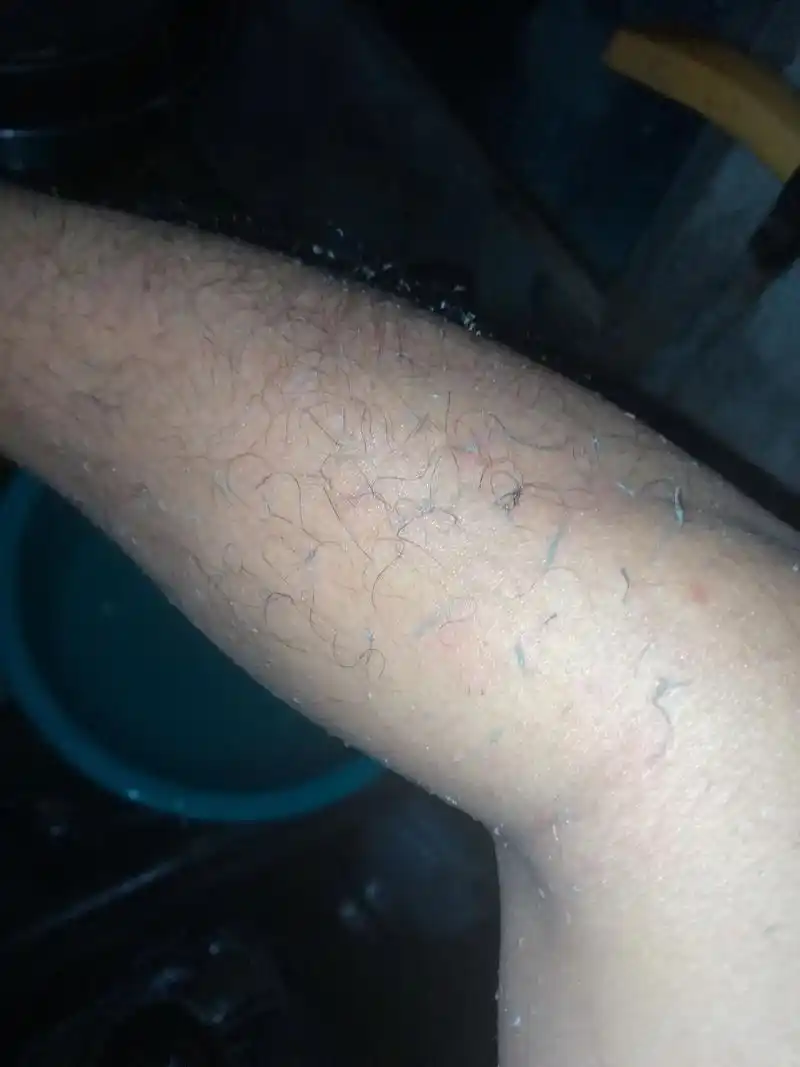 冬天鱼鳞病皮肤你会洗出这样的感觉吗