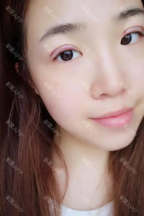埋线双眼皮