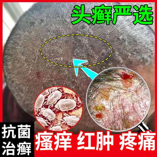 治疗头皮痒脂溢性皮炎特痒效药专用药头皮癣头癣药银屑头皮屑头上长红