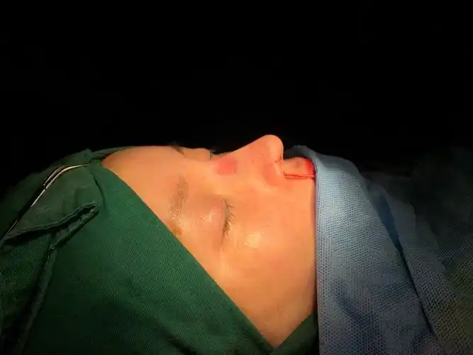 术前鼻子萎缩 漏鼻孔 鼻小柱突出 鼻翼圆后缩严重 _圈子-新氧美容整形