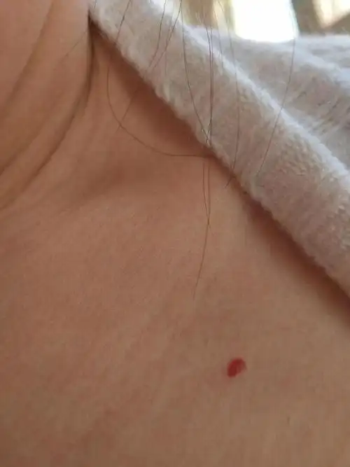 身上长了好多小红点不知道是什么?