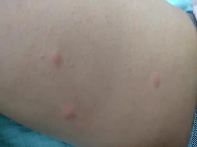 一觉醒来觉得大腿痒得不行,居然起了三个包,百度一下是丘疹型荨麻疹