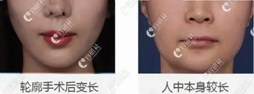 有没有能把长脸变短的手术?韩国改脸型口碑医院有哪些?
