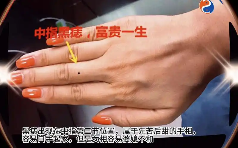 中指第三节出现黑痣!