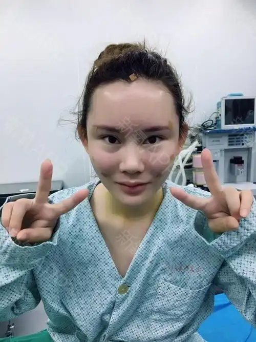 不问归期123自体脂肪全脸填充第215天美丽日记