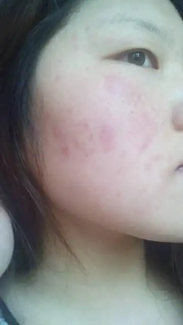 我的皮肤属于敏感型请问我这是过敏吗?有什