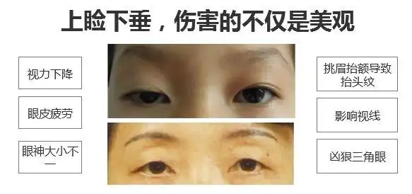 什么是上睑下垂?判断标准是什么?