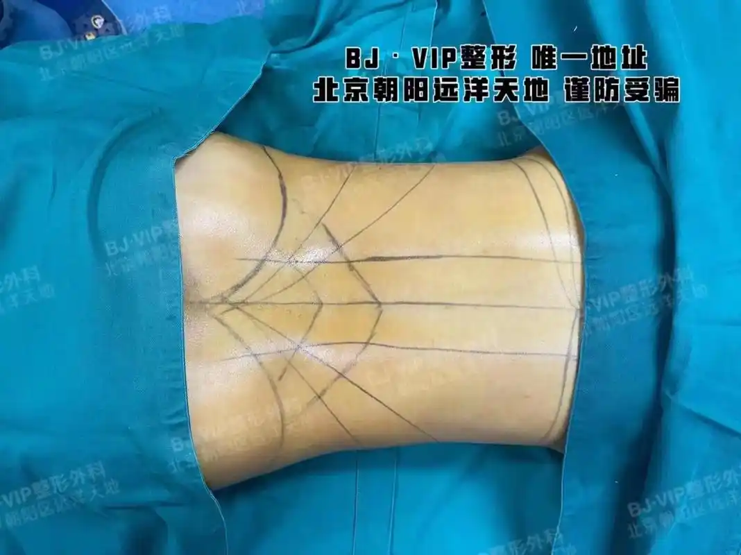 美杜莎腰臀比蚂蚁腰-腰腹环吸 丰臀丰胯96腰间双c线吸出来, - 抖音