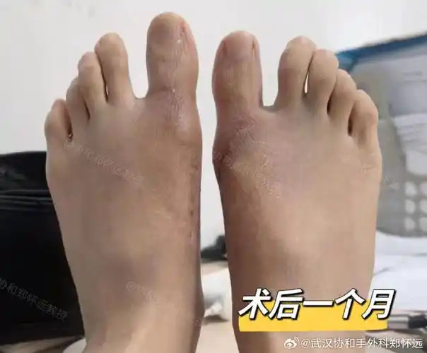 近来,有些拇外翻患者在就诊时,会询问道:微创手术一定要打螺钉吗?