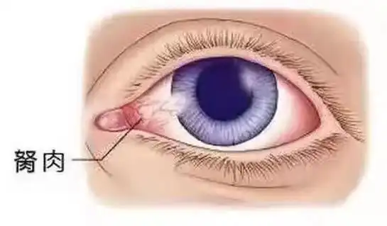 胬肉,拼音:nǔ ròu,中医指眼球结膜增生而突 - 抖音