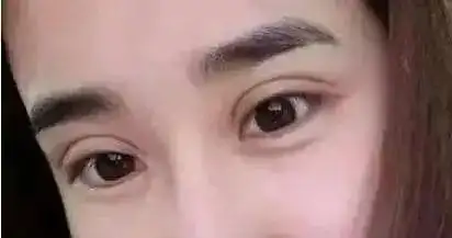 双眼皮的宽与窄