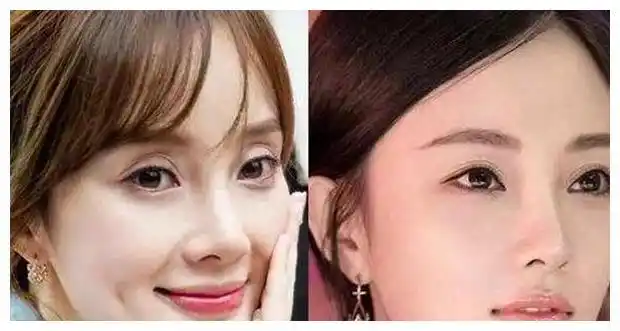 明星割双眼皮前后对比