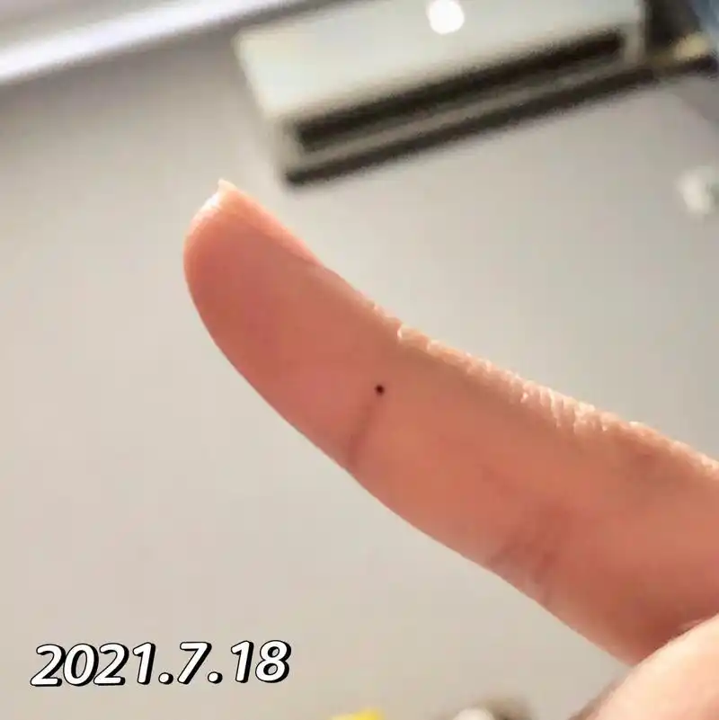 真的会长痣啊 右手手指头侧面长了个痣,看着它越来越清晰 用手打字就