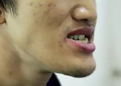 宝宝牙齿出现"地包天"咋办?别错过"最佳治疗时间",家长牢记