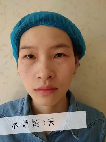 提肌无力 - 眼镜不够大,无神 整形科普来啦