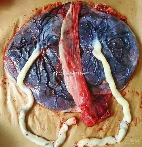 看到一个双胞胎胎盘的胎盘表面,两胎之间的羊膜腔之间有厚厚的分隔膜