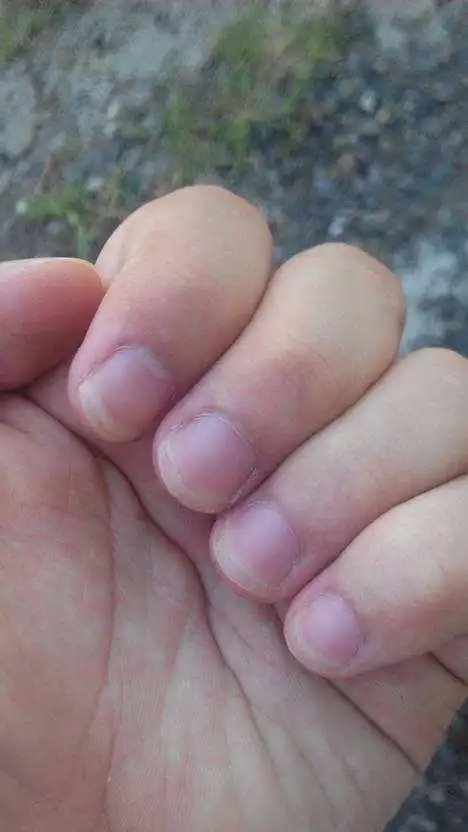 心脏病的手指甲,心脏不好的人指甲是什么样子的?-图片大观-奇异网