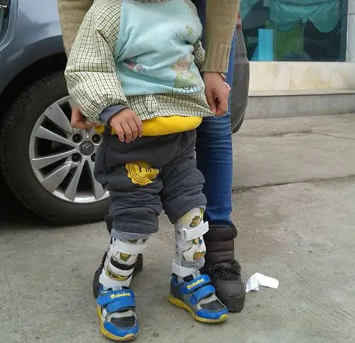 小孩足外翻矫形案例|矫形器案例|湖南佳满假肢 您的假肢装配专家!