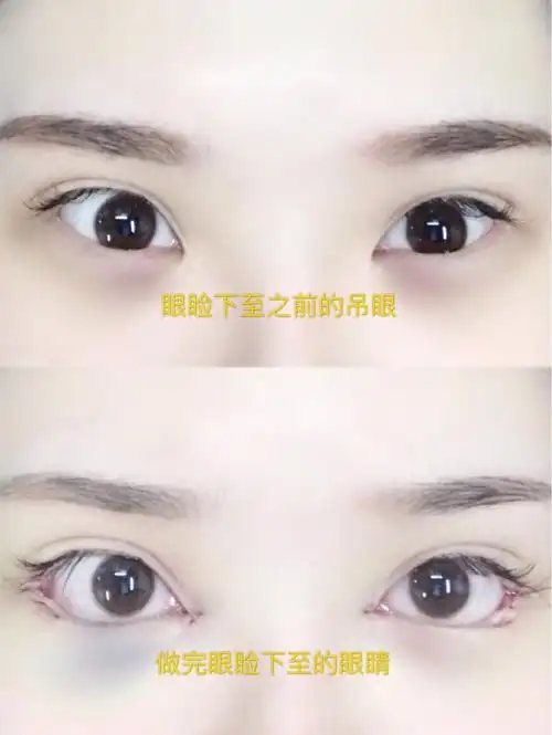 关于眼睑下至手术我有话要说